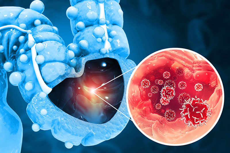Colorectal Cancer Surgery: Common Myths Explained