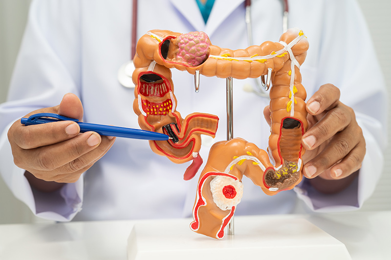 A doctor guiding a patient through a colon polypectomy